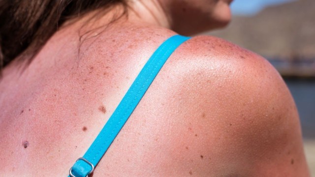 woman-sunburn-beach