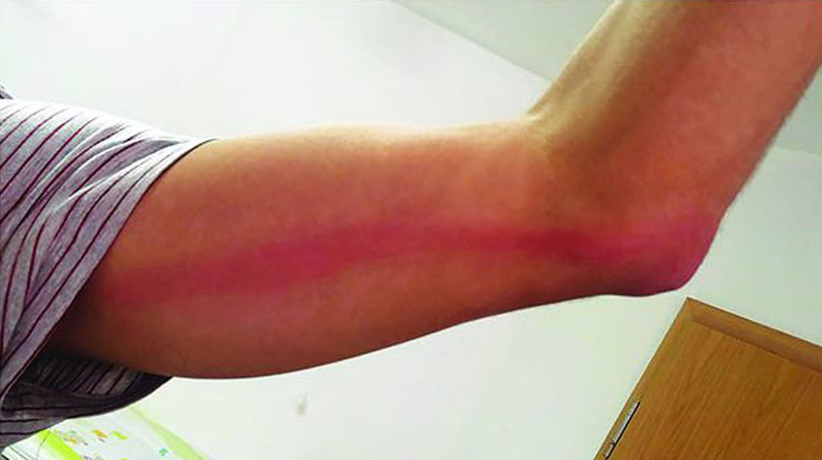 ლიმფანგიტი