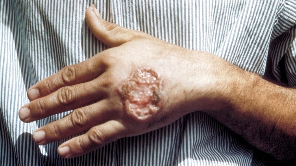 ლეიშმანიოზი