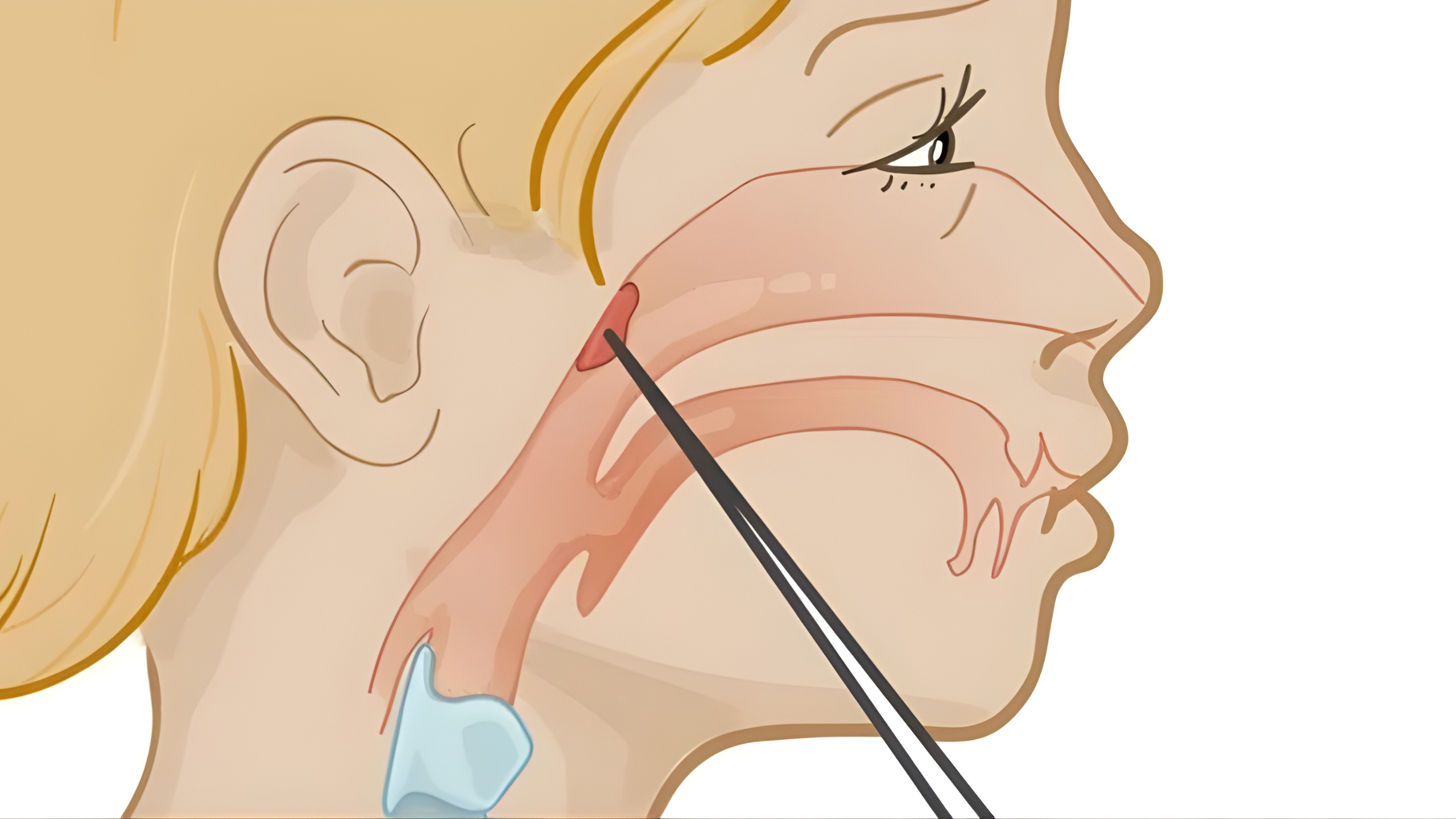 ადენოიდები