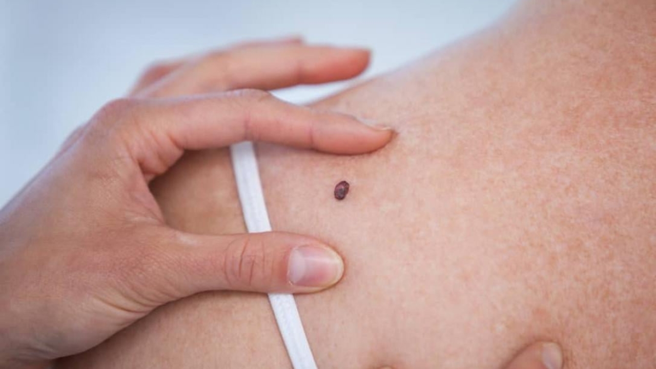 მელანომა